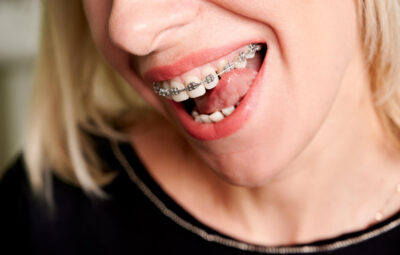 Czy aparat samoligaturujący zmienia rysy twarzy?